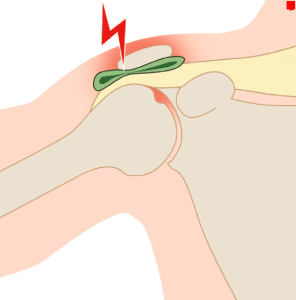 Rotary cuff damage